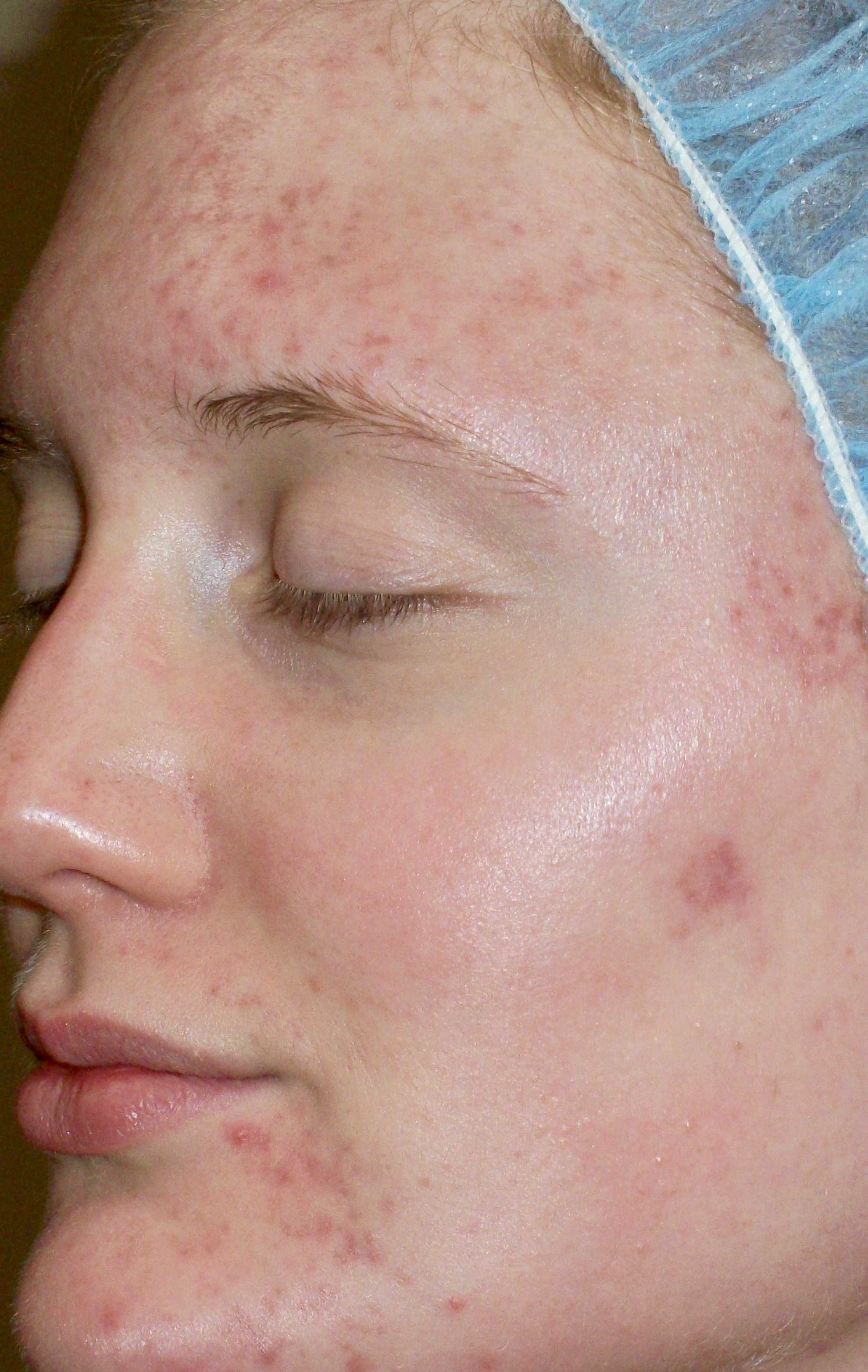 woman with inflammatory acne on the face