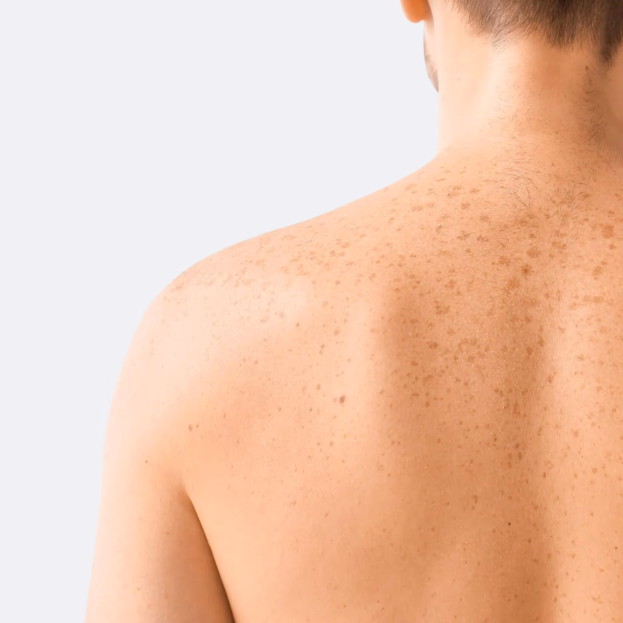 Nærbilde av en persons nakne rygg med fregner og solflekker. Personens hår er kort og lysebrunt, men ansiktet er ikke synlig. Bakgrunnen er en vanlig lys grå fa