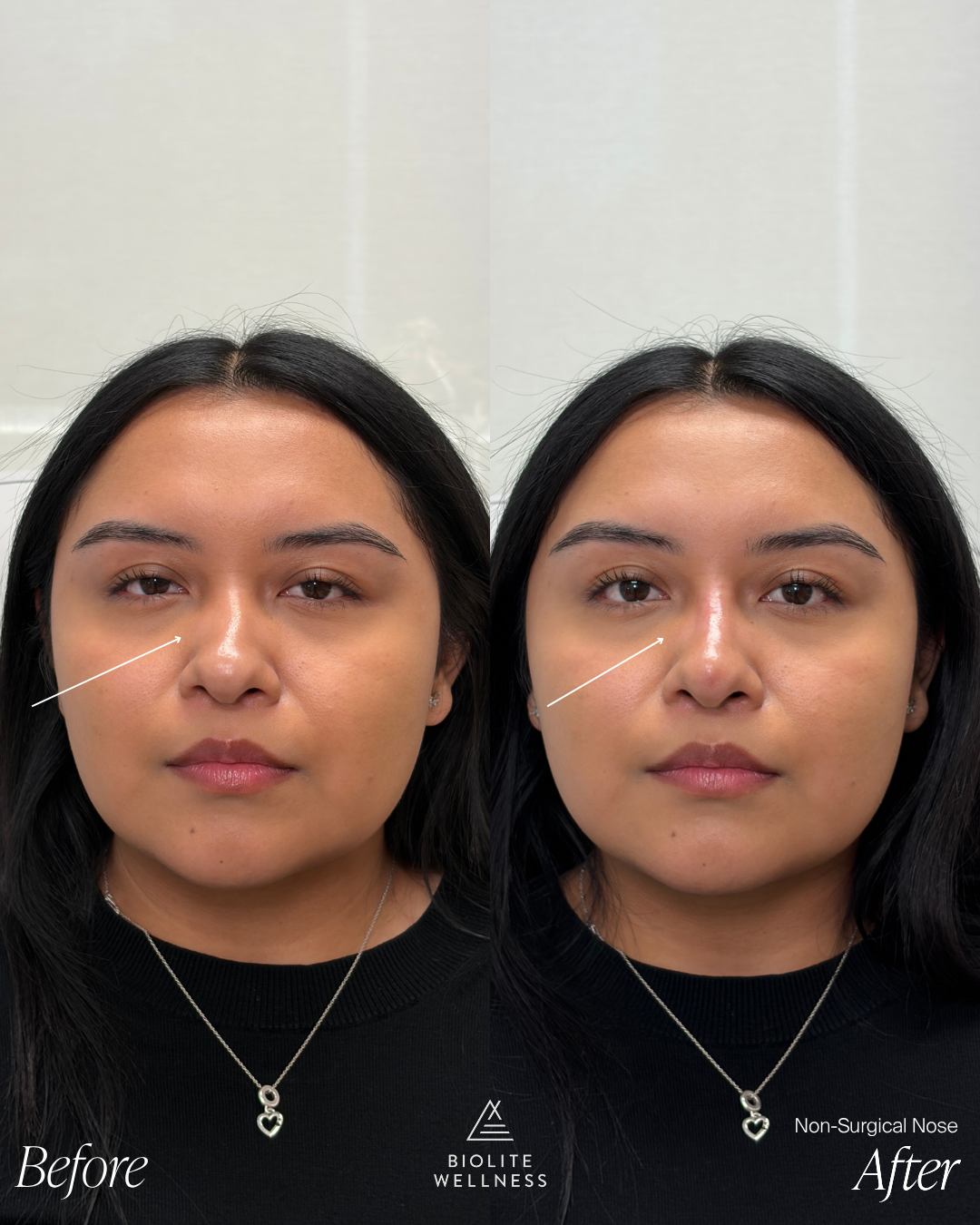 Before and after photo of non-surgical nose treatment results at Biolite Wellness