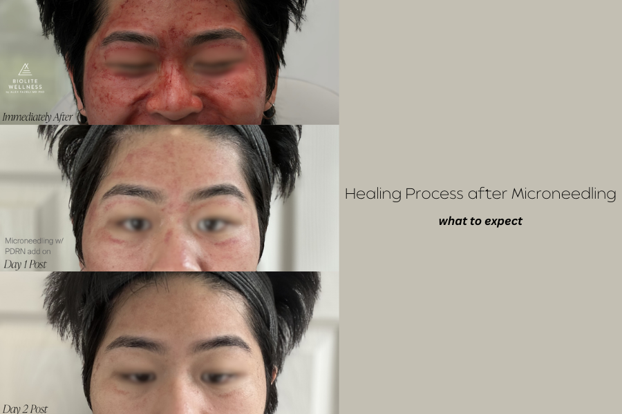 How microneedling works at Biolite Wellness in Irvine