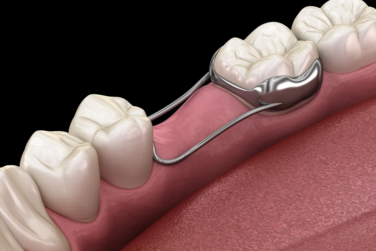 Space Maintainers: Protecting Your Child's Adult Teeth After Early Loss