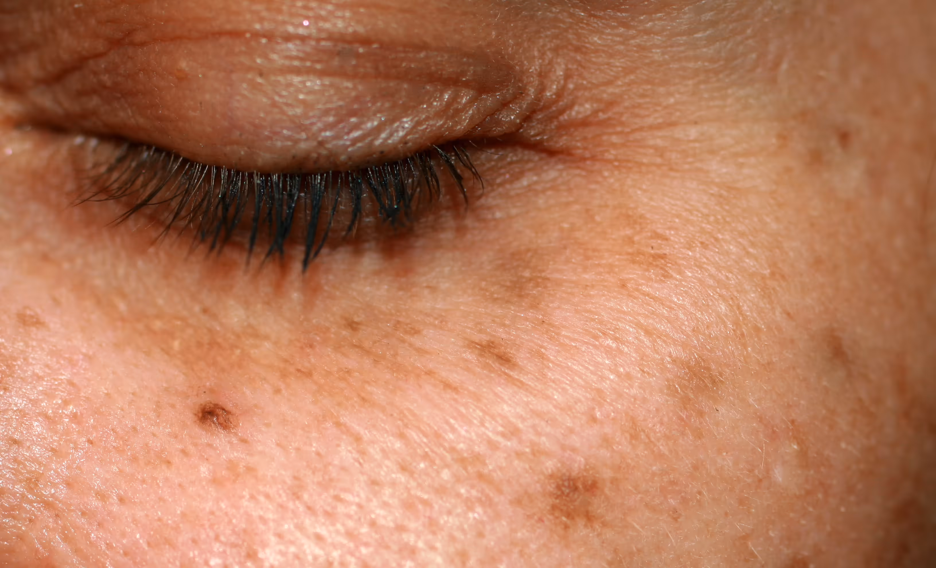 Age Spot Symptoms and Treatment. Surgery for skin lesions and minor hand conditions at The Minor Surgery Center (TMSC).