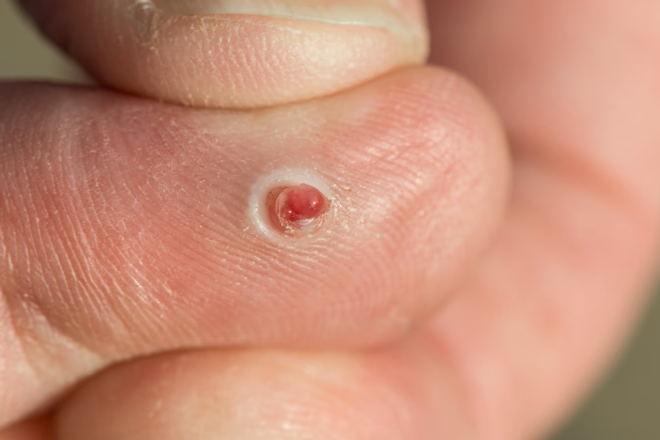 Pyogenic Granulomas Symptoms and Removal. Surgery for skin lesions and minor hand conditions at Toronto Minor Surgery Center (TMSC).