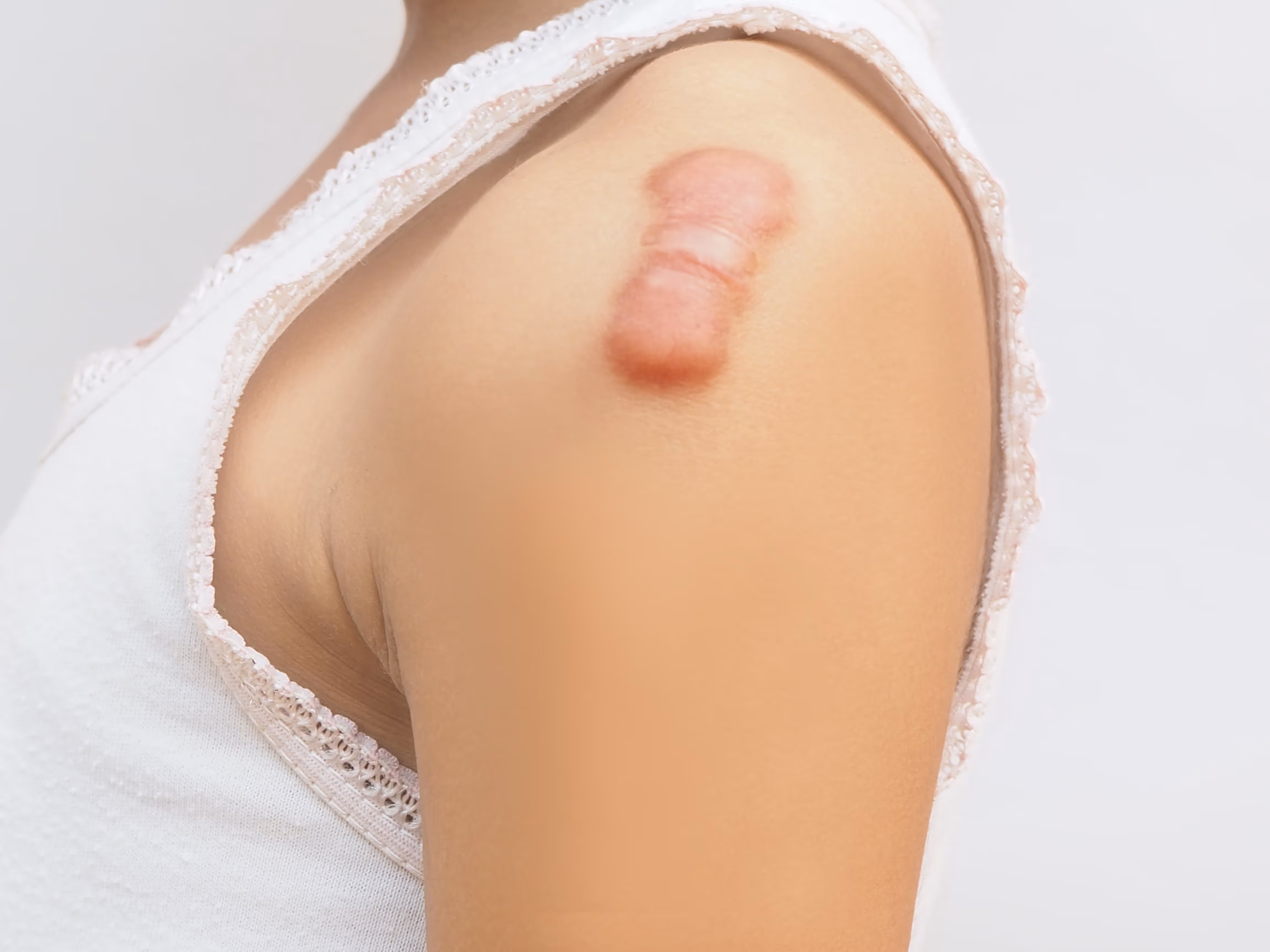Keloid Scar Symptoms and Treatment. Surgery for skin lesions and minor hand conditions at Toronto Minor Surgery Center (TMSC).