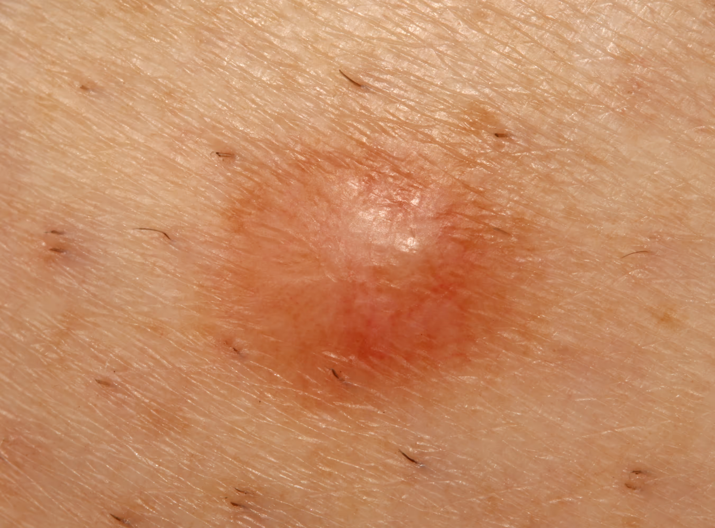 Dermatofibroma symptoms. Surgery for skin lesions and minor hand conditions at Toronto Minor Surgery Center (TMSC).