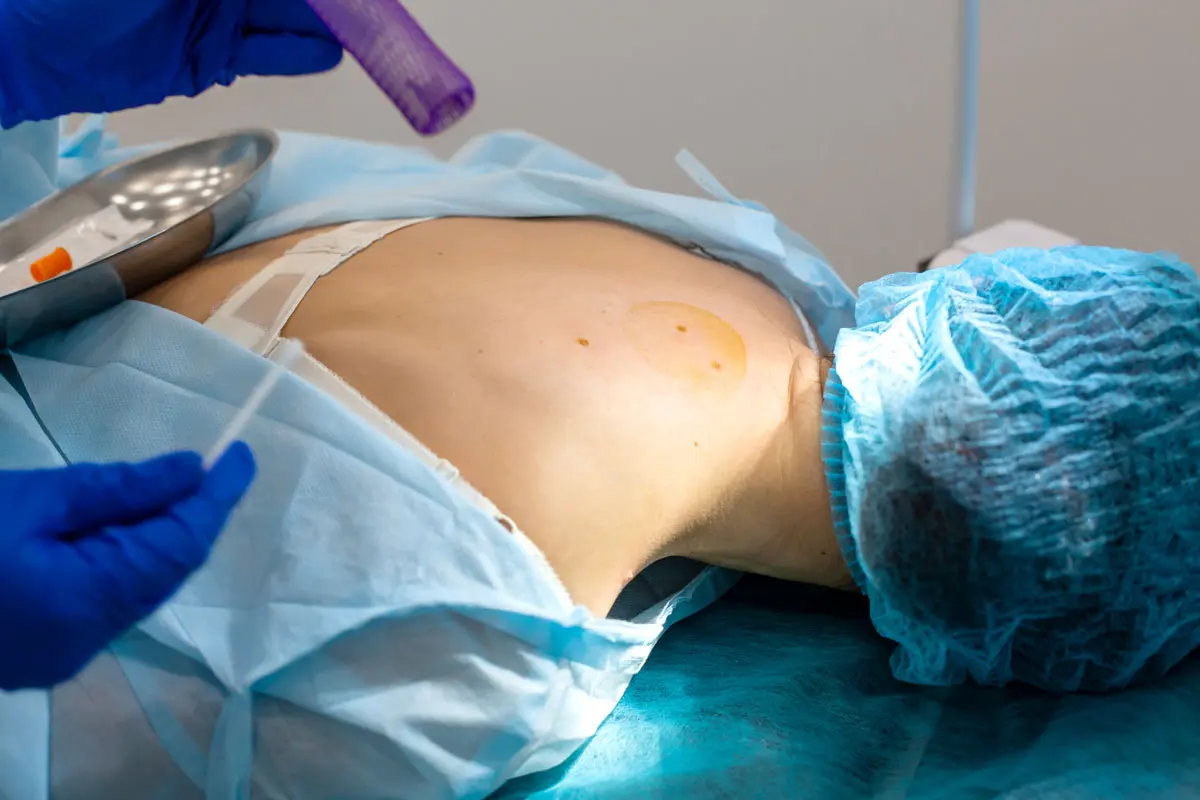 The surgeon does surgery to remove the mole on the patient's back.