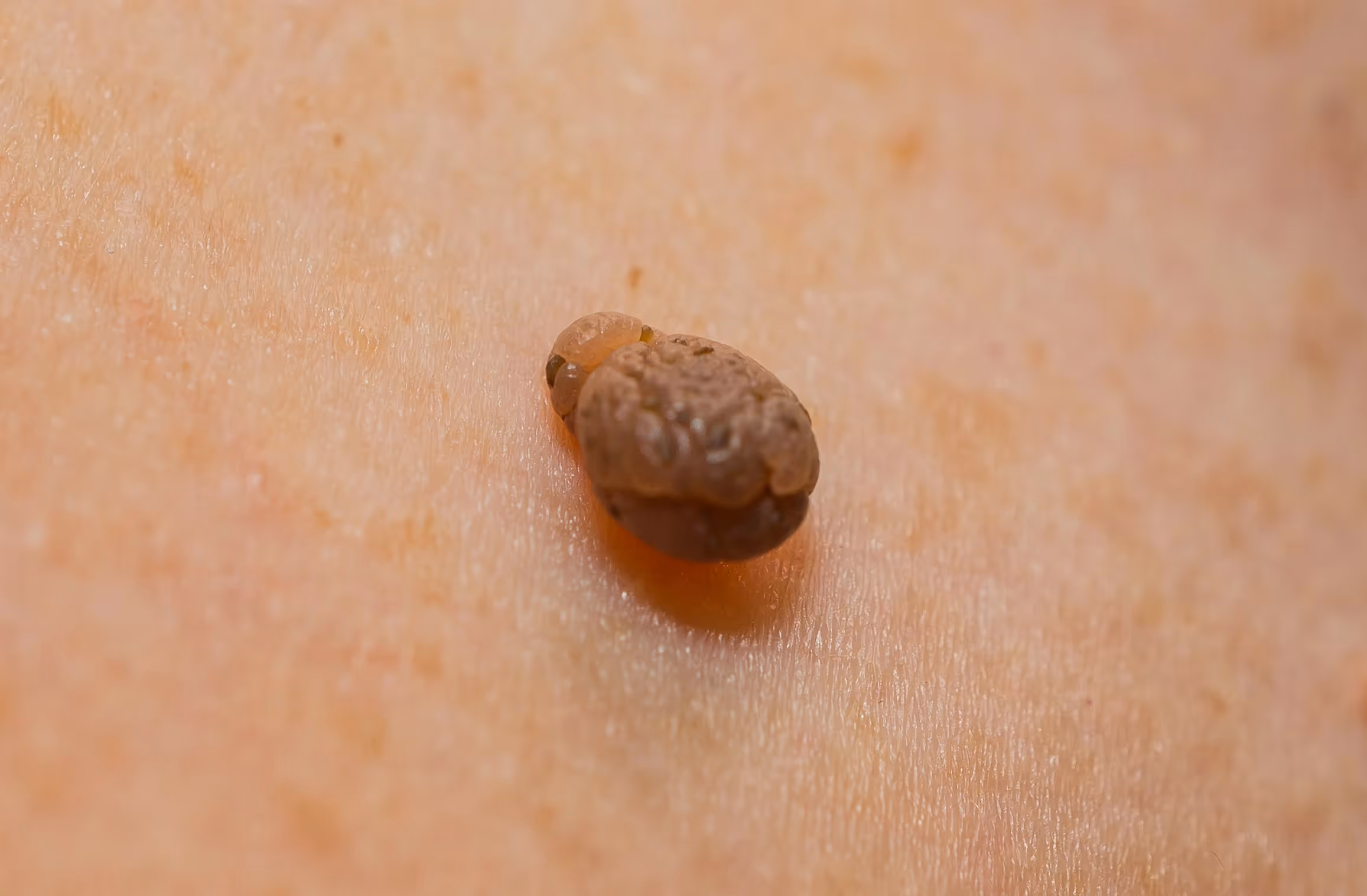 Seborrheic keratosis symptoms. Surgery for skin lesions and minor hand conditions at Toronto Minor Surgery Center (TMSC).