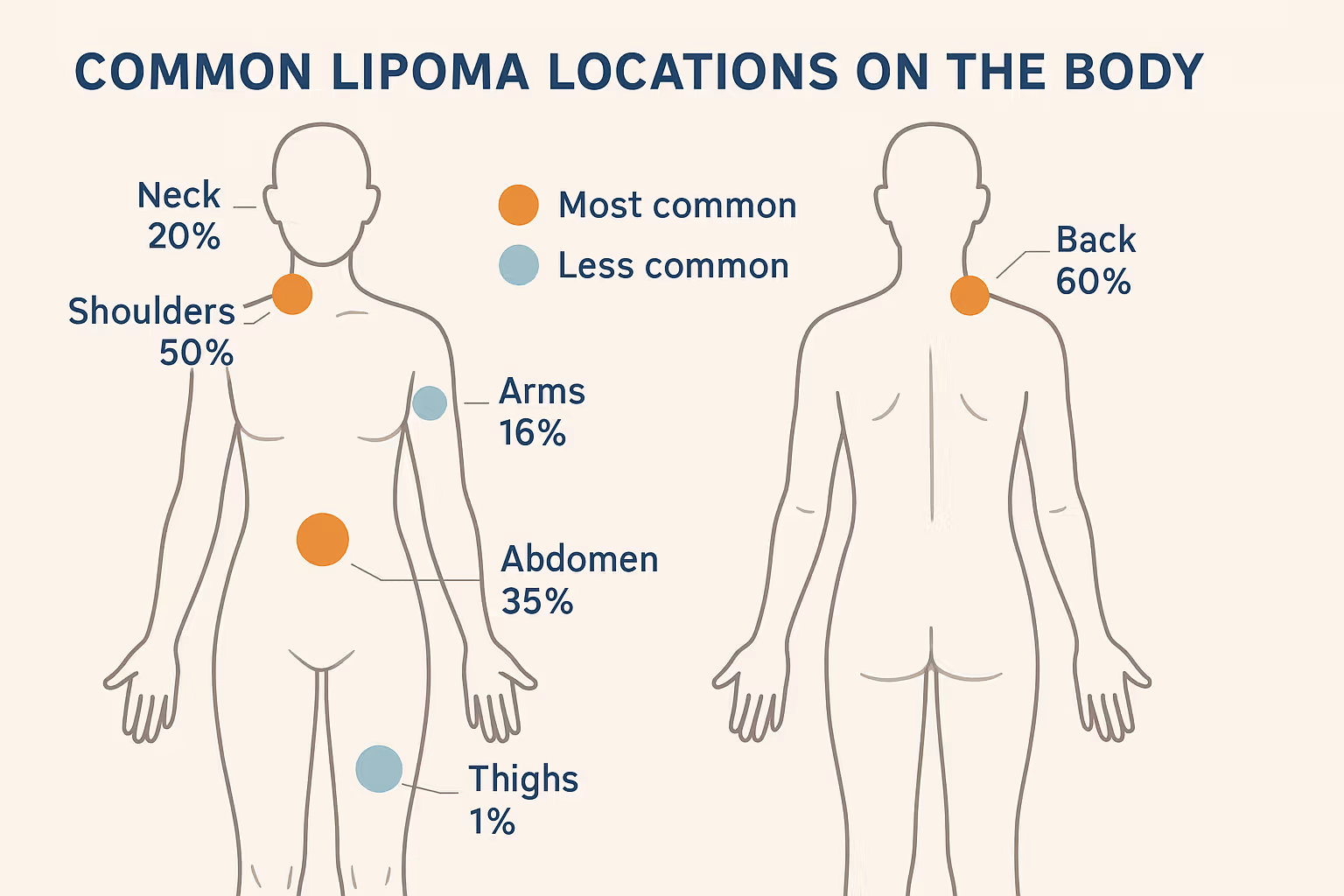 Landscape infographic (1536x1024) titled "Common Lipoma Locations on the Body" showing a simple human body outline (front and back view) wit