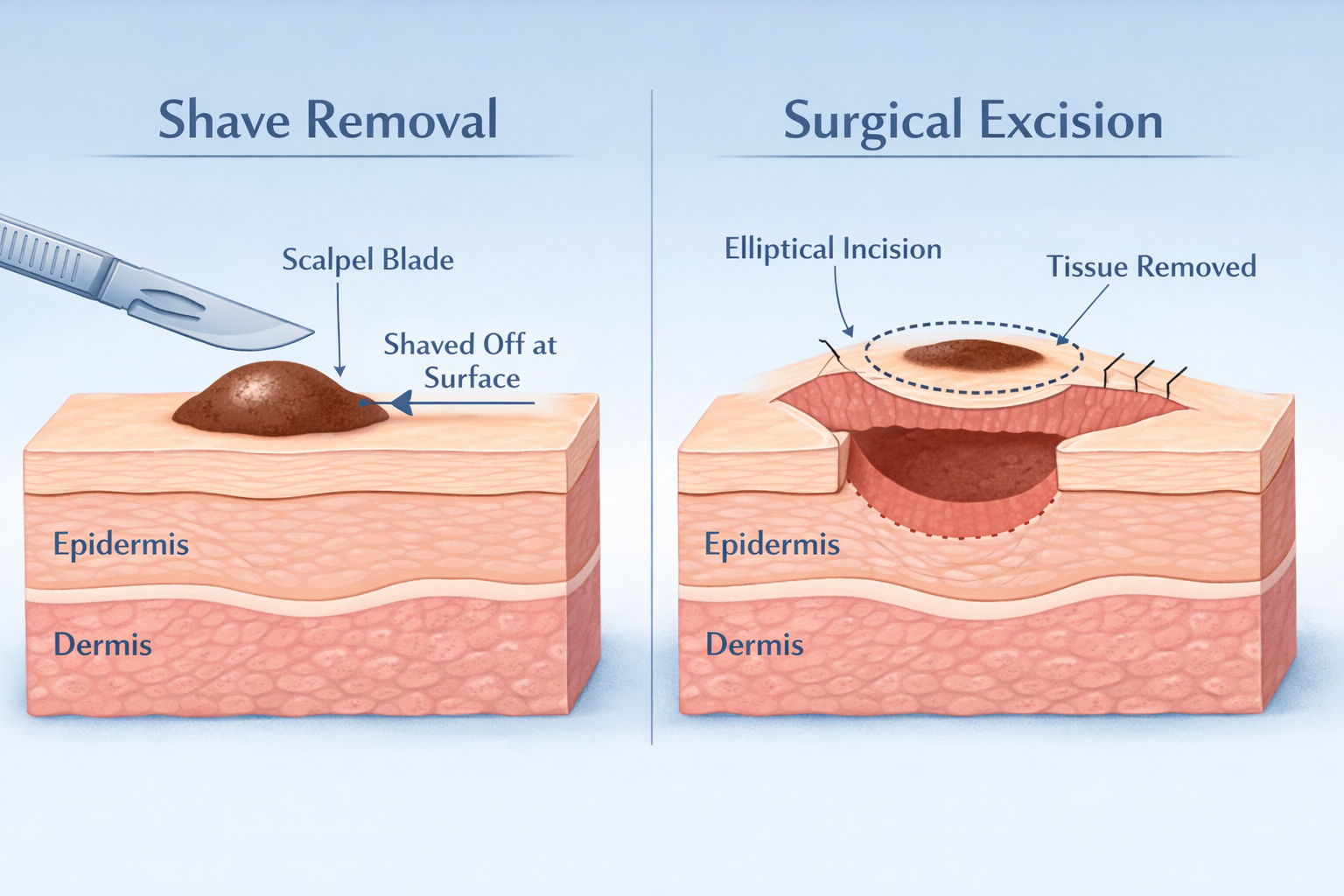 Detailed landscape format (1536x1024) medical illustration showing a side-by-side comparison of shave removal technique versus surgical exci