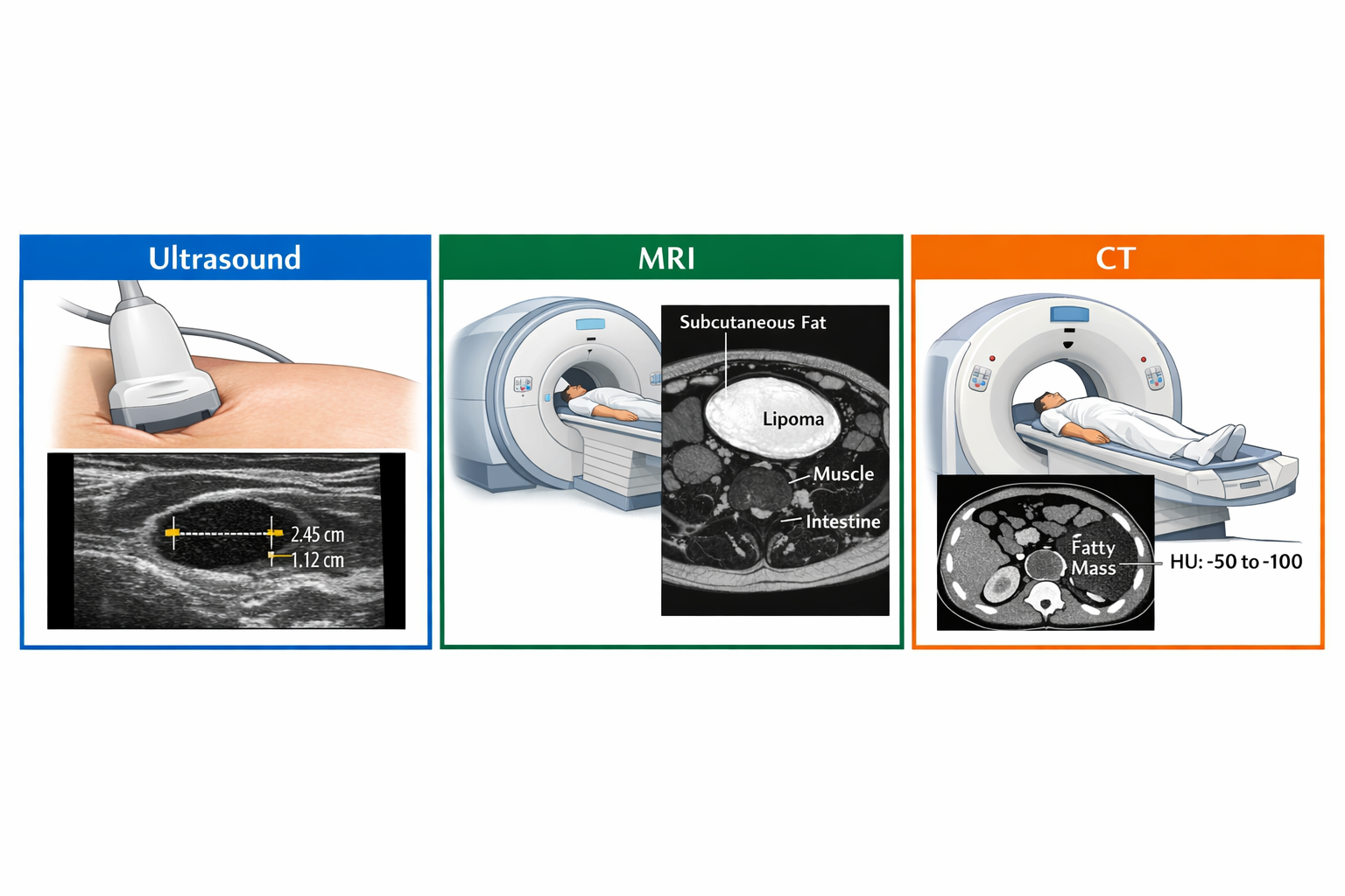 Detailed landscape format (1536x1024) medical illustration showing side-by-side comparison of three imaging modalities for lipoma detection.