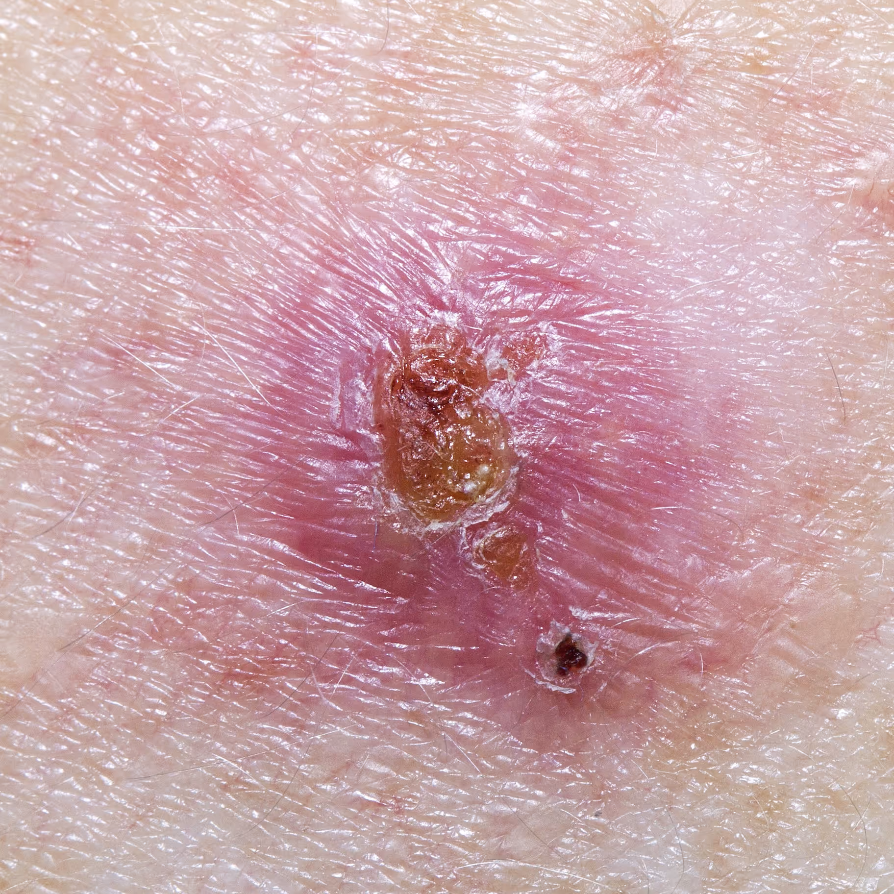 what skin cancer looks like
