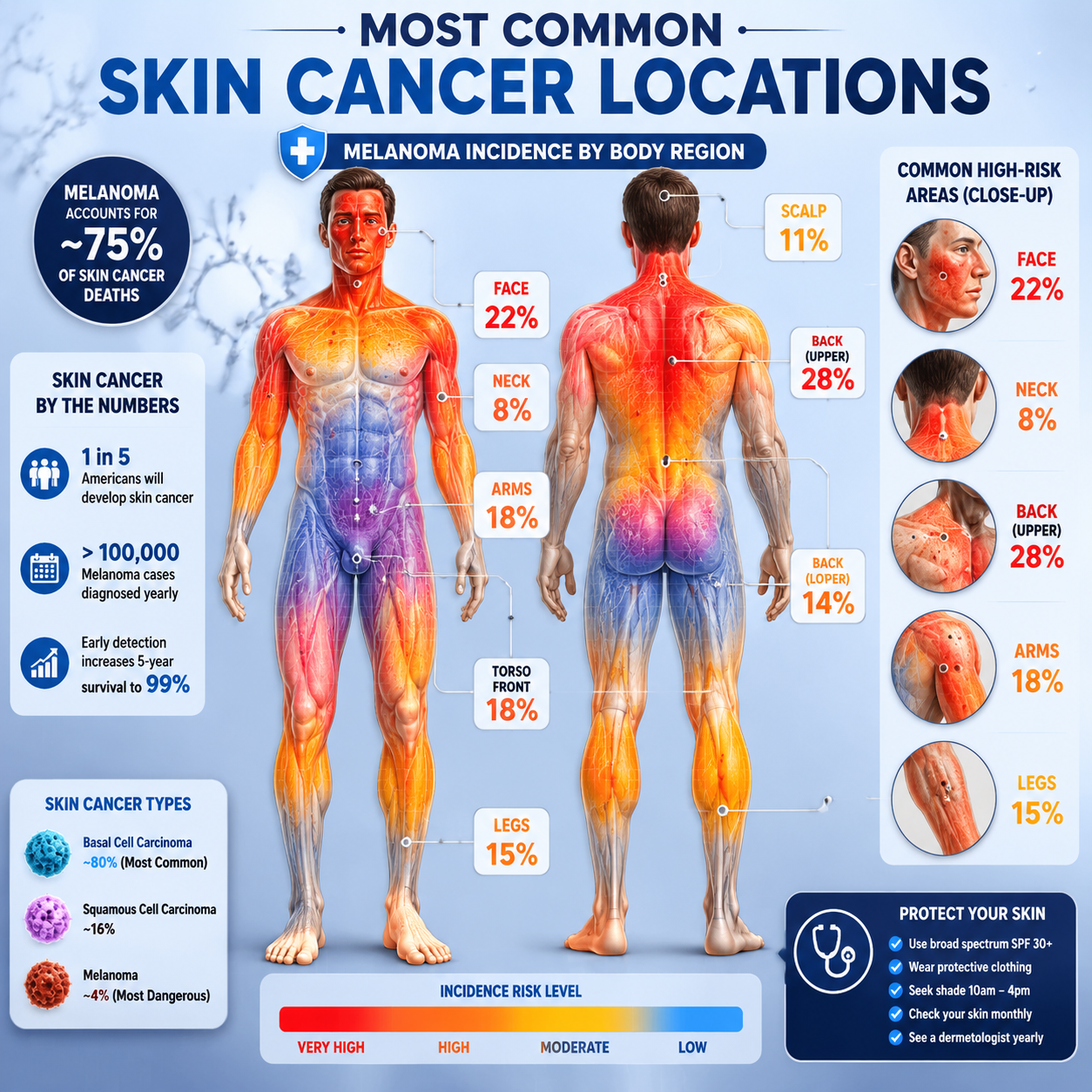Anatomical body map highlighting most common skin cancer locations with heat map visualization. Full human silhouette with