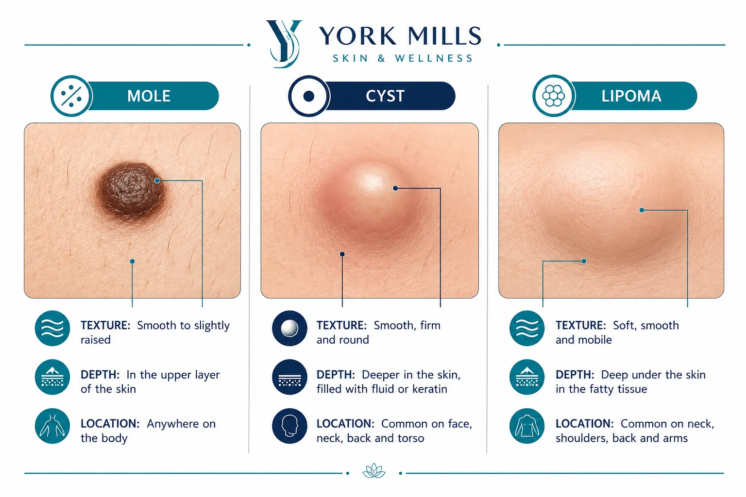 Where to Get a Mole, Cyst or Lipoma Removed Near York Mills: The Short Answer