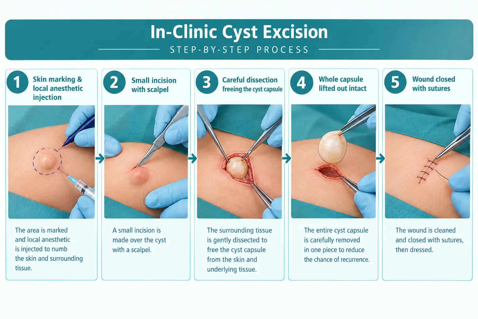 What Types of Cysts Can Be Removed With Drainage