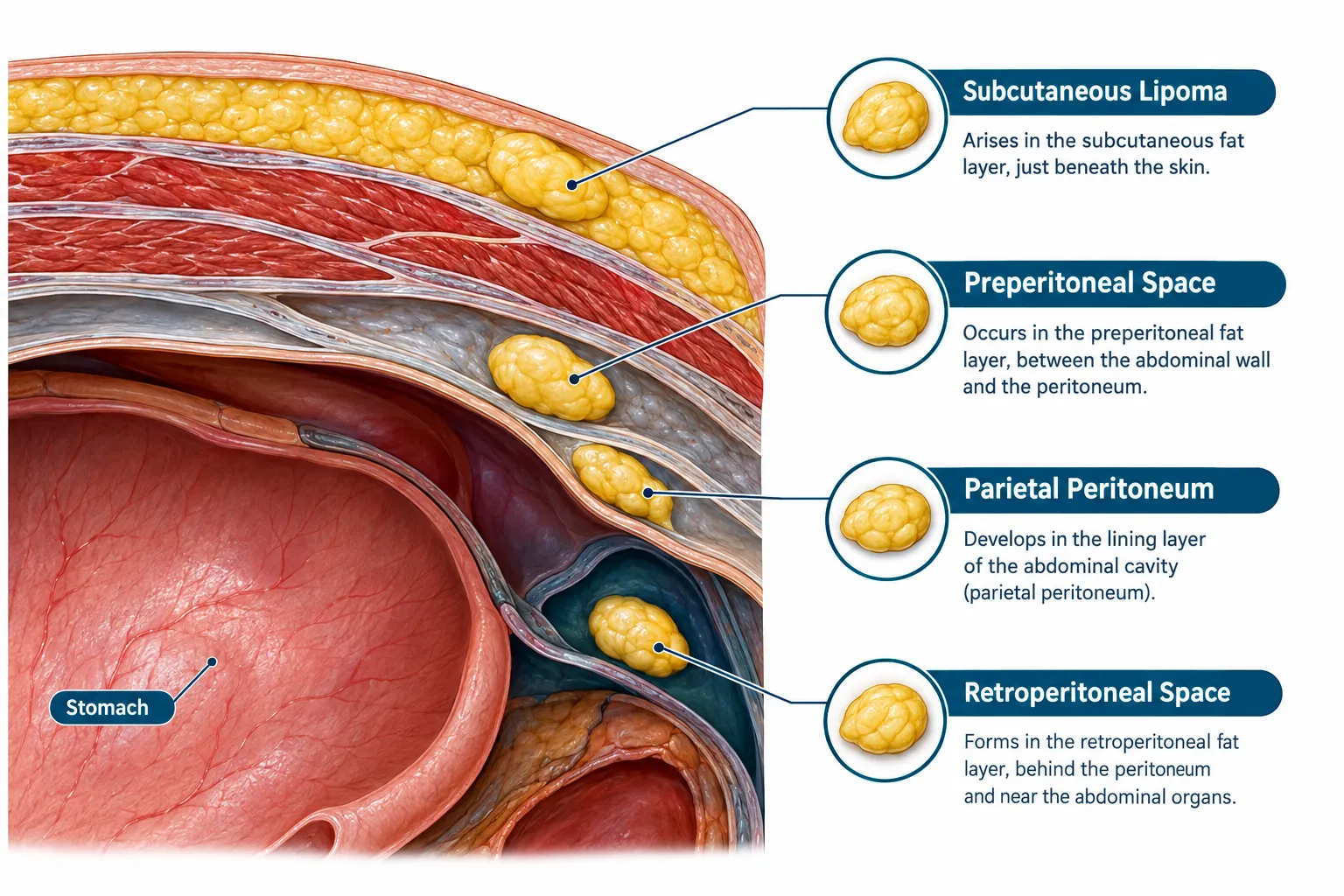 What Is a Lipoma and Why Do They Form on the Stomach?