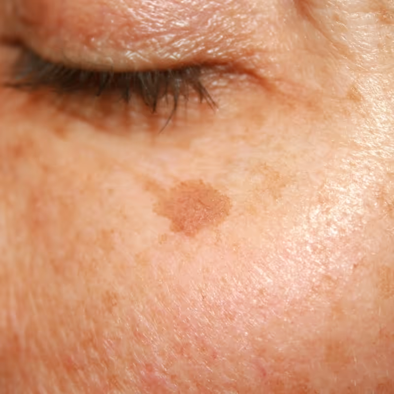 age spot removal