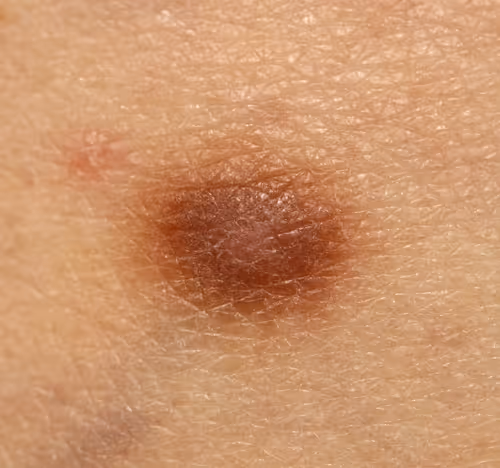 Dermatofibroma Removal at The Minor Surgery Center