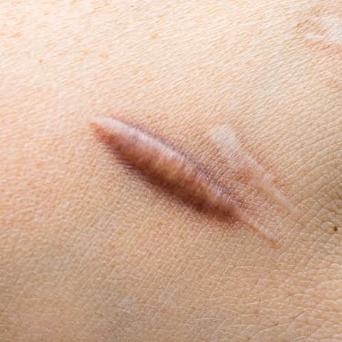 Keloid Scar Removal