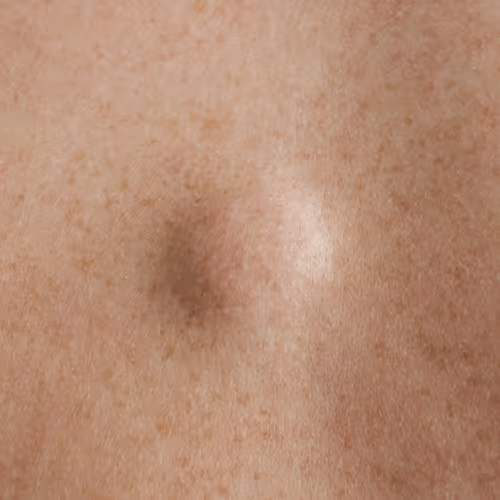 Lipoma Removal Toronto
