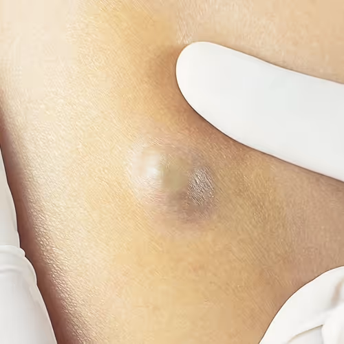 Sebaceous Cyst Removal