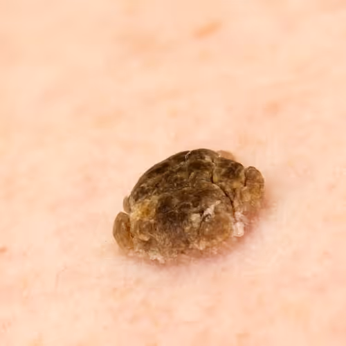 Seborrheic Keratoses Removal