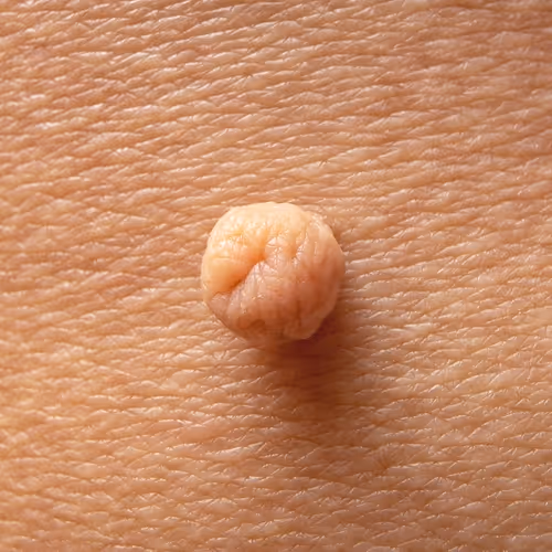 Skin Tag Removal