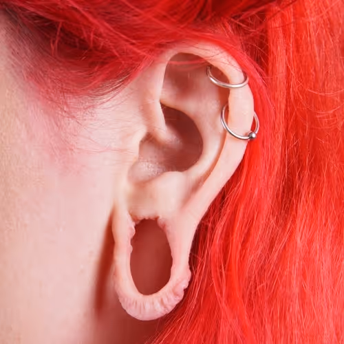 Split Earlobe Repair Toronto