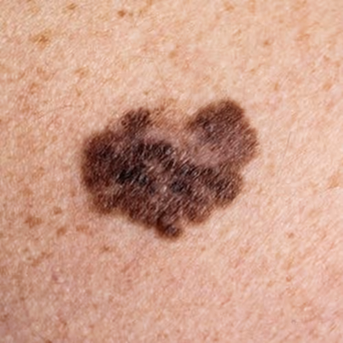melanoma surgery toronto