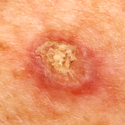 Squamous Cell Carcinoma Surgery Toronto