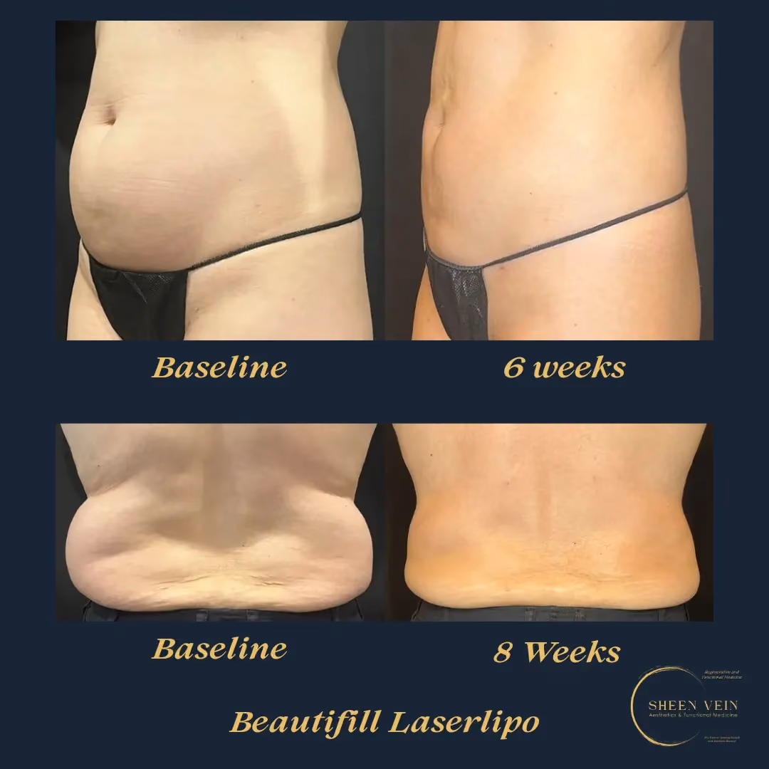 Laser Lipo with BeautiFill