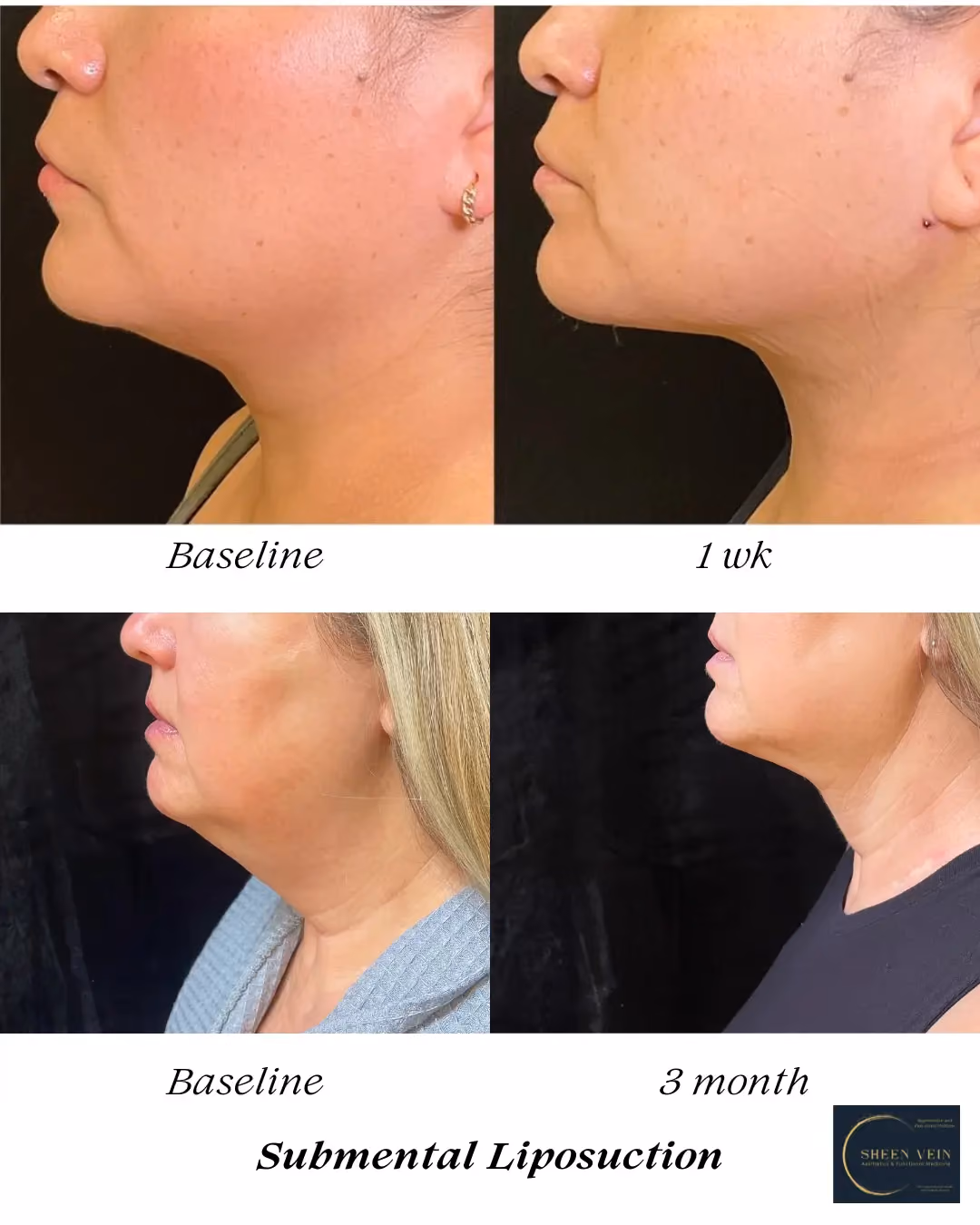 Laser Lipo with BeautiFill