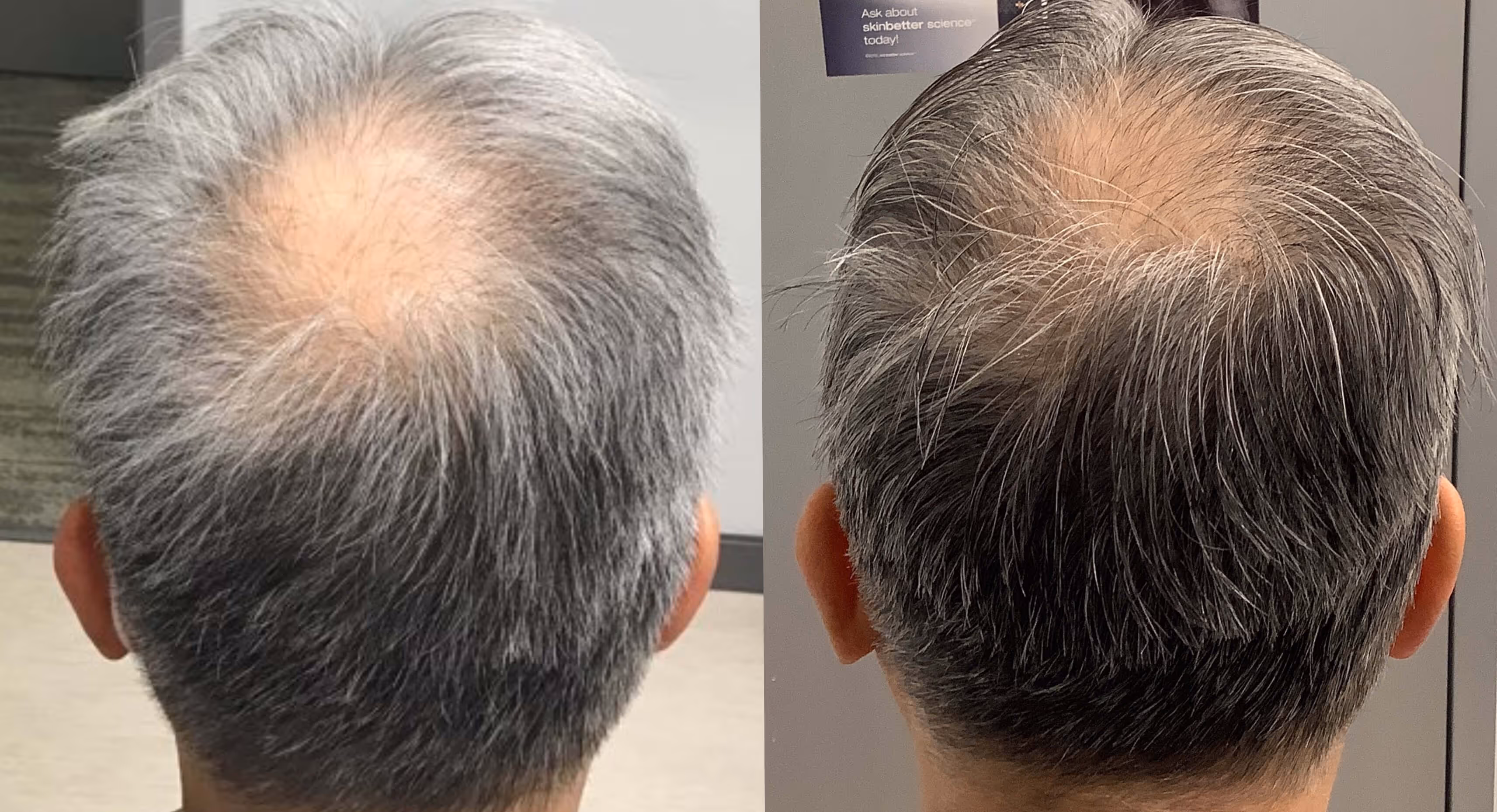 The back of a man's head with gray hair.