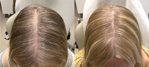 Before and after pictures of a woman's hair loss.