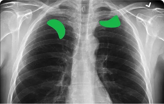 Chest X-ray image showing lungs with two highlighted green areas near the upper lobes.