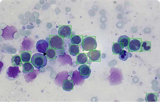 Microscopic view of blood cells with several dark purple cells outlined in green boxes indicating detected cancerous or abnormal cells.