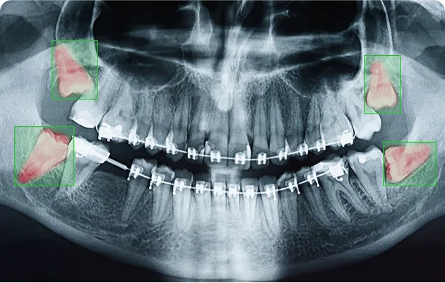 Panoramic dental X-ray showing teeth with braces and four highlighted impacted wisdom teeth in green boxes.