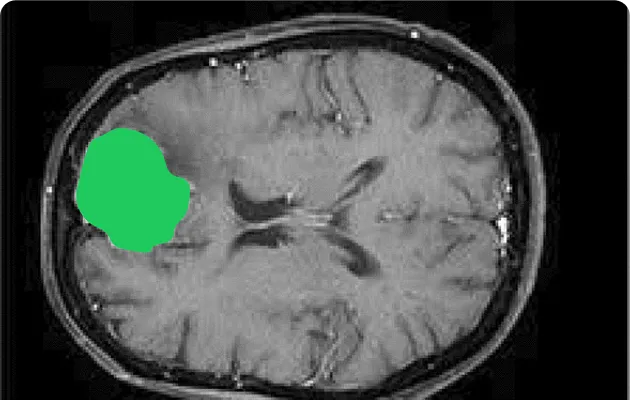 MRI brain scan showing a highlighted tumor area in the left frontal lobe.