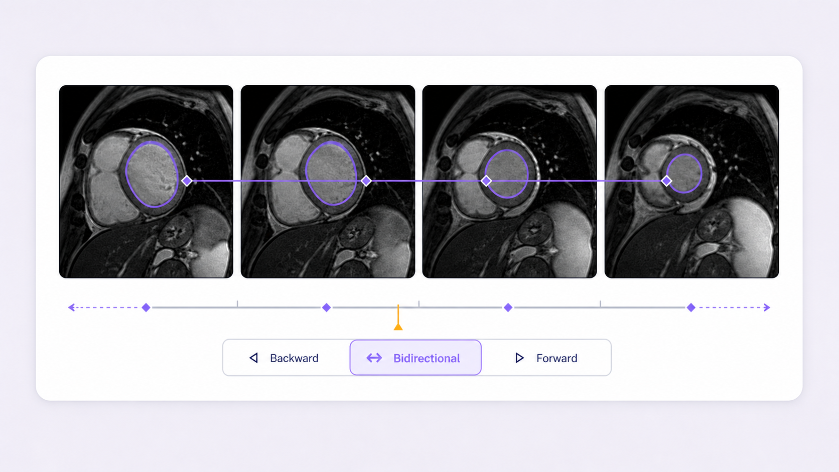Four cardiac MRI frames with a lesion contour tracked bidirectionally across the sequence