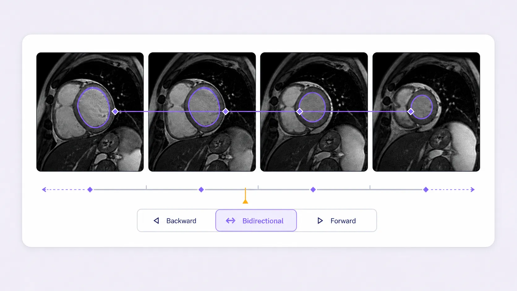 Four cardiac MRI frames with a lesion contour tracked bidirectionally across the sequence
