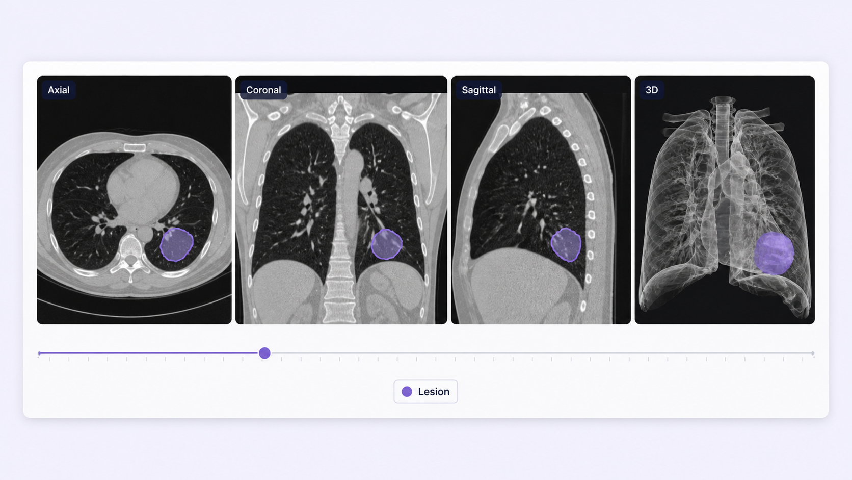 Synchronized axial, coronal, sagittal, and 3D DICOM views with a consistent lesion segmentation