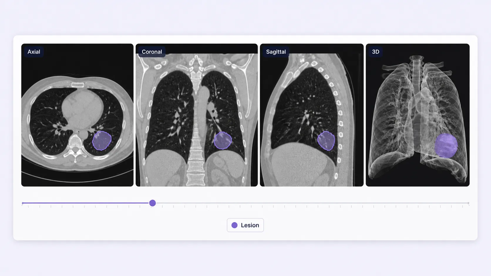 Synchronized axial, coronal, sagittal, and 3D DICOM views with a consistent lesion segmentation
