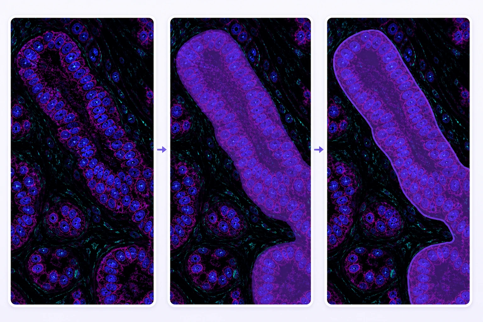 Synthetic pathology field progressing from raw image to a structure-aligned mask and editable pixel-precise boundary.