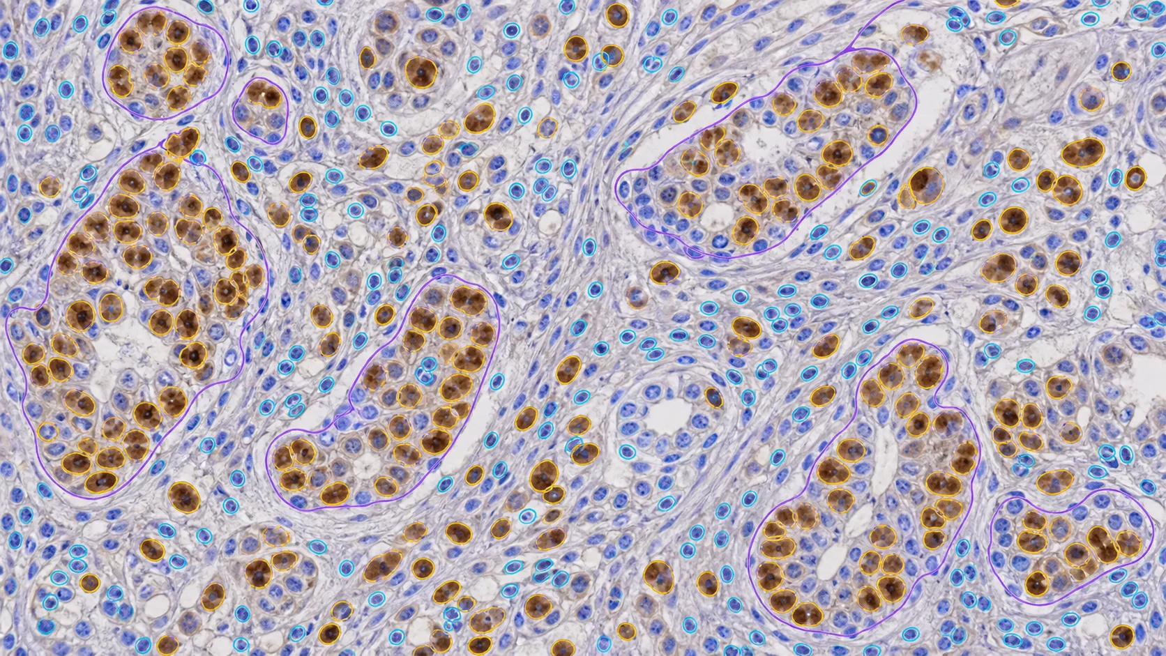 Pathology cells and matching regions prepared for biomarker pattern analysis.