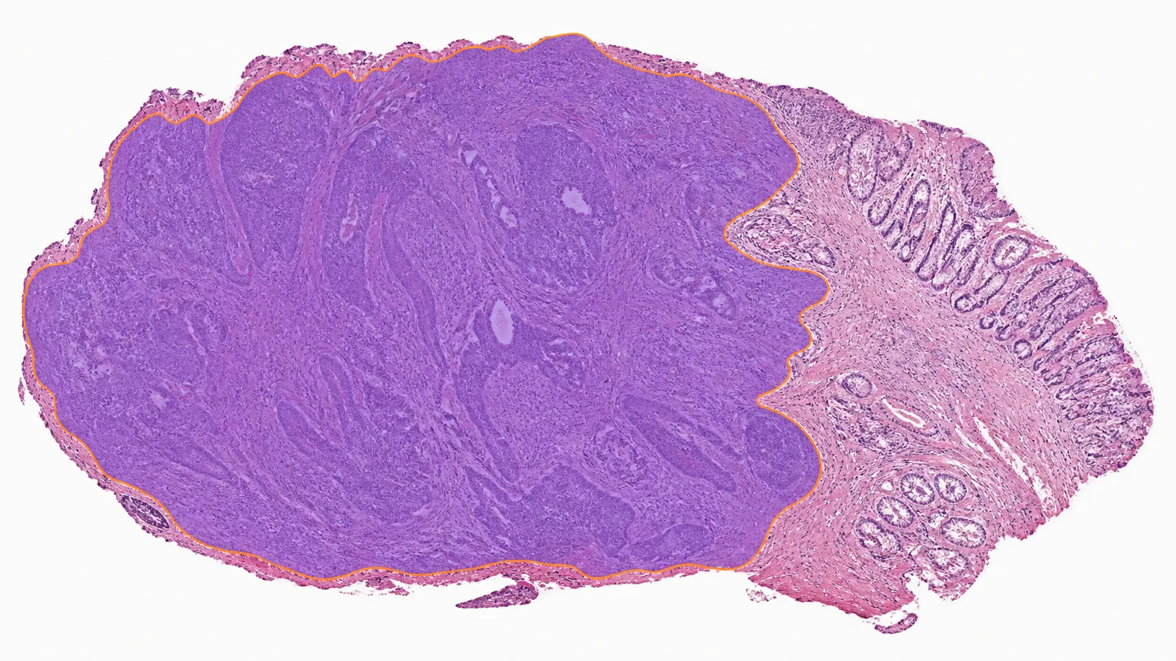 Whole-slide pathology view with focused tumor region and cellular detail.