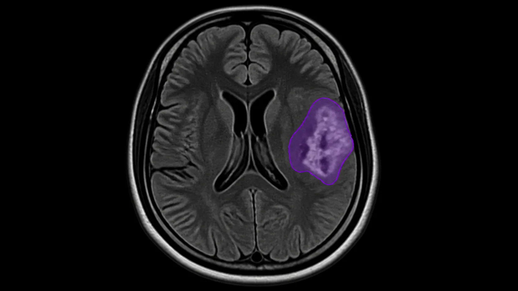 AI-assisted medical segmentation with editable tumor and lesion masks.