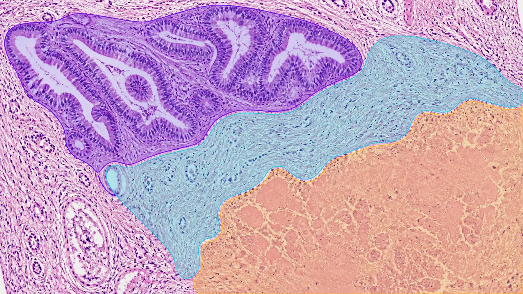 Pathology tissue progressing from image to precise editable segmentation mask.