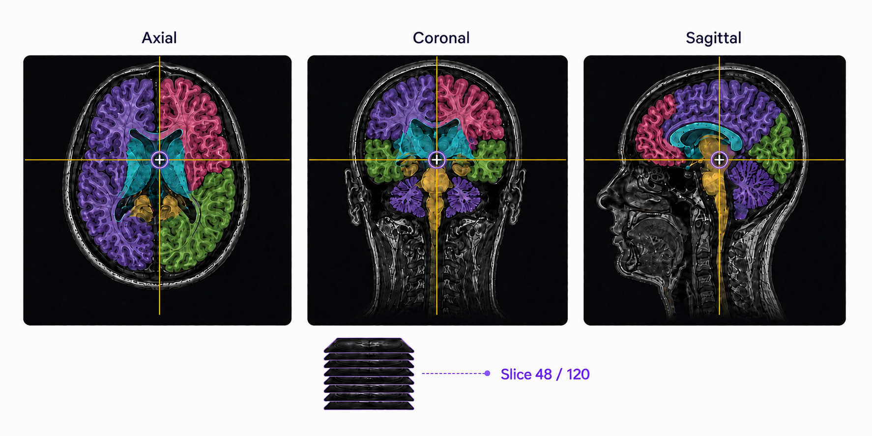 Multiplanar medical annotation Axial, coronal, and sagittal brain MRI views with synchronized cursors and integrated multi-class segmentation