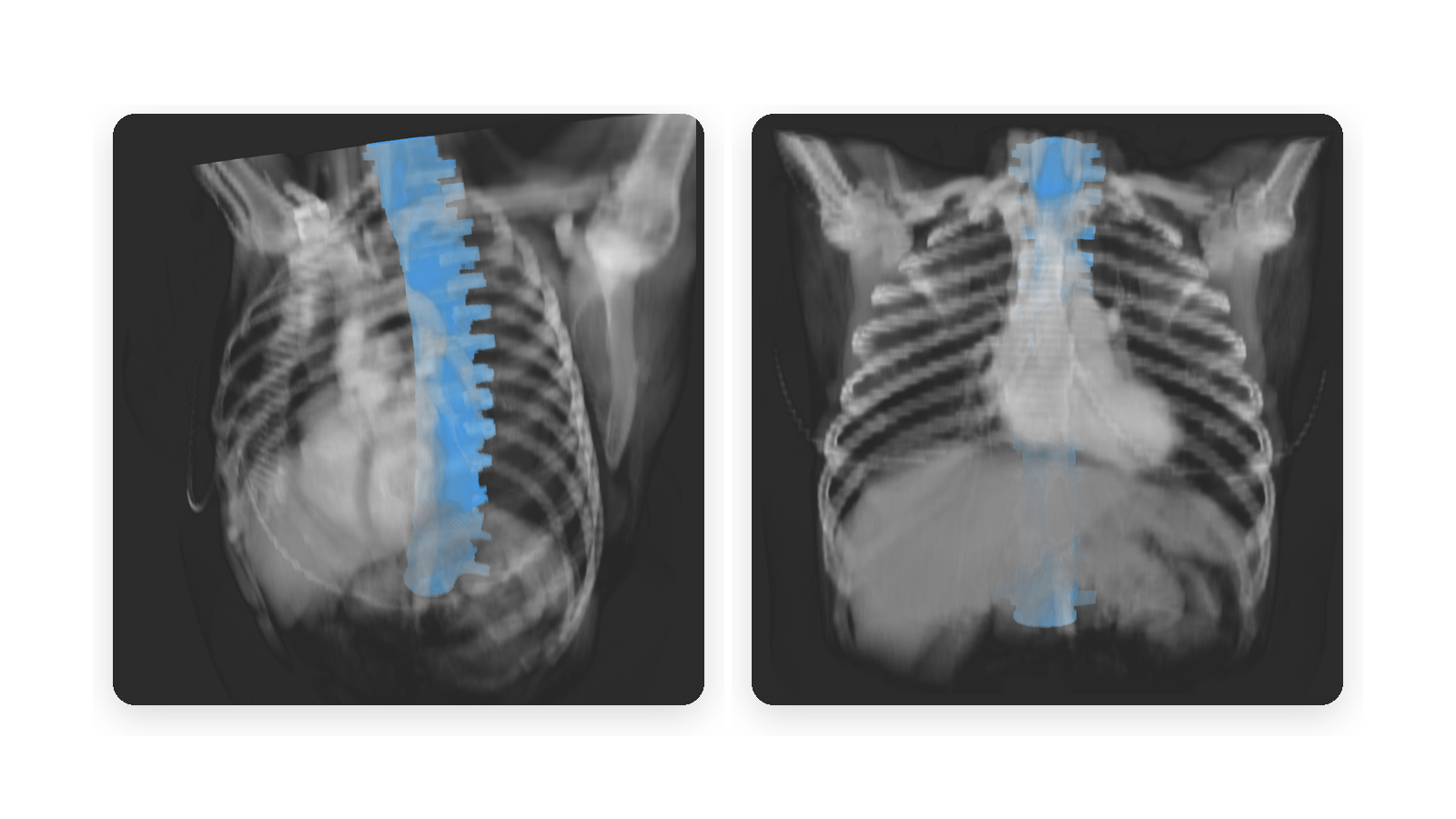 Interactive 3D medical annotation Two equal-sized real 3D spine annotation views on a white background