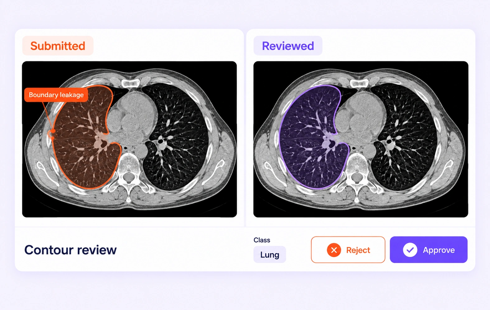 A lung contour leaking into chest-wall tissue is compared with the corrected boundary. A lung contour leaking into chest-wall tissue is compared with the corrected boundary.