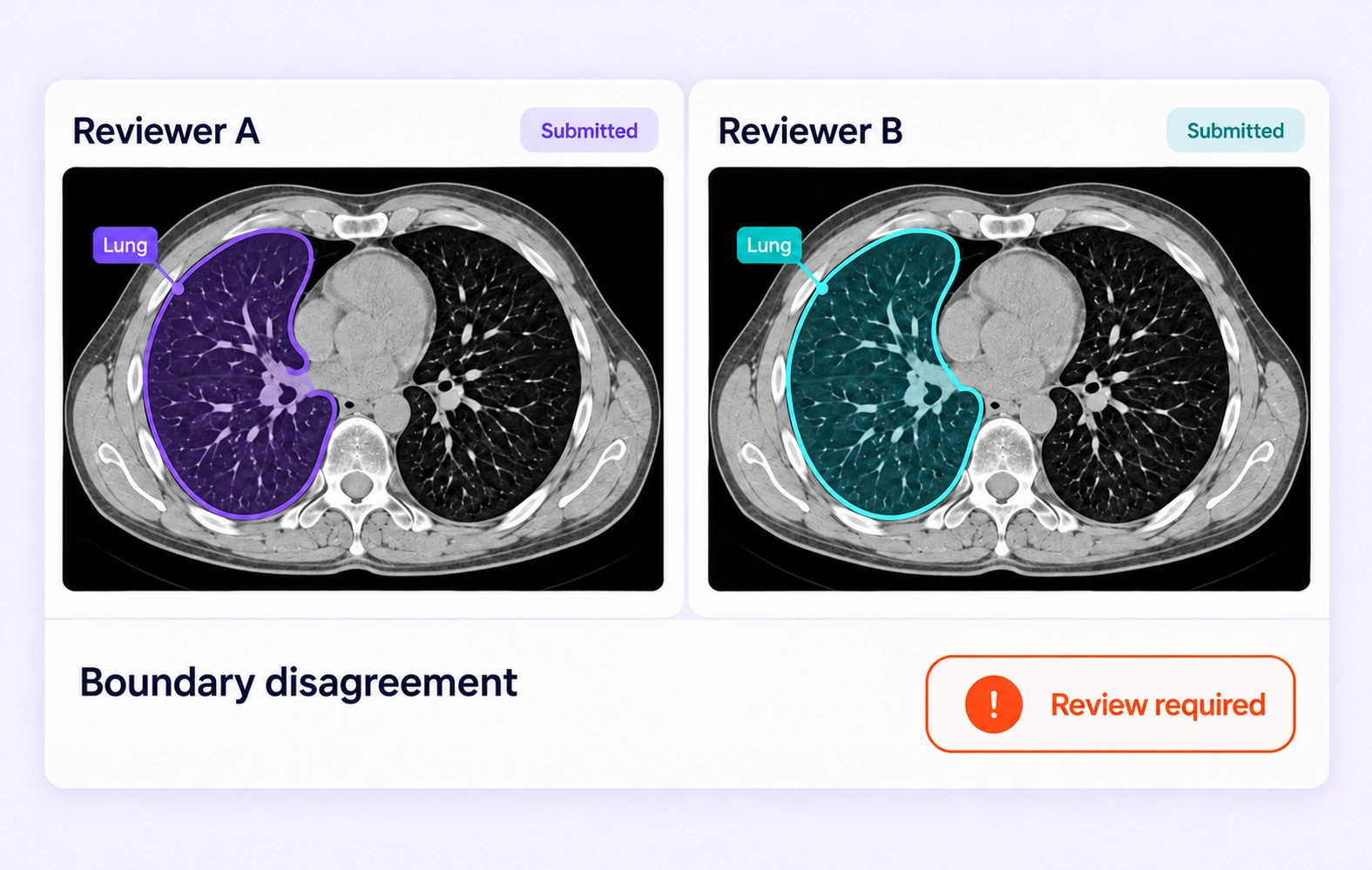 Two reviewers’ lung contours differ at a small boundary region and require review. Two reviewers’ lung contours differ at a small boundary region and require review.